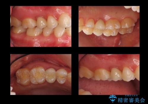 歯の高さがなく、しょっちゅう外れる 他院で治療途中だが病院を変えたいの治療後