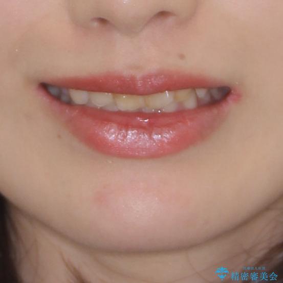 気になる前歯を美しく マウスピース矯正とセラミッククラウンの治療前(顔貌)