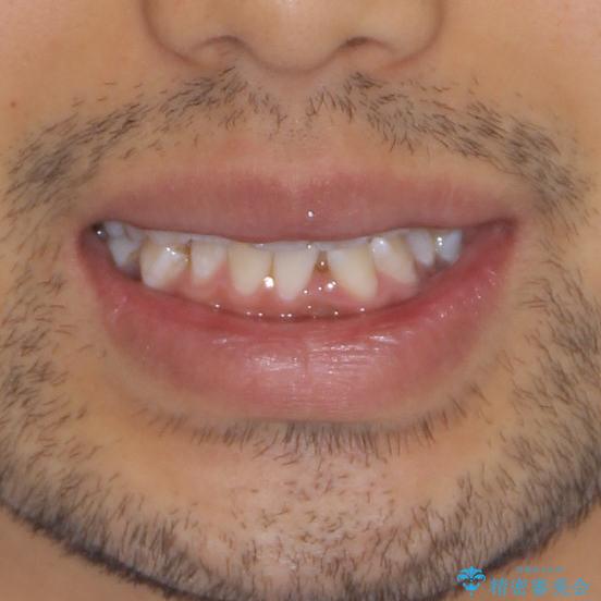 前歯の叢生を解消　ワイヤー装置での抜歯矯正の治療前（顔貌）