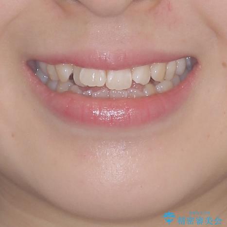 気になるデコボコとオープンバイト インビザラインでの矯正治療の治療前(顔貌)