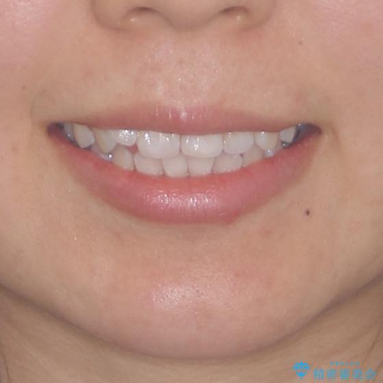 前歯のデコボコが気になる インビザラインによる矯正治療の治療前(顔貌)