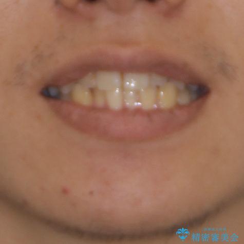 前歯のクロスバイトをインビザラインで矯正治療の治療前（顔貌）
