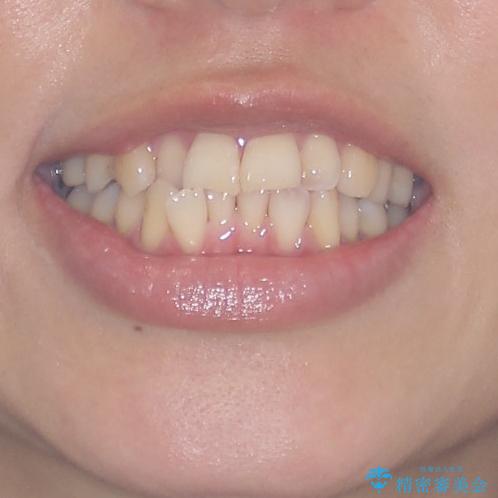 切端咬合をインビザライン矯正で解消の治療前(顔貌)