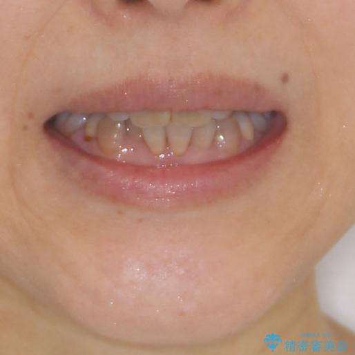 矯正の後戻りと変色歯を治したい　総合歯科診療の治療前（顔貌）