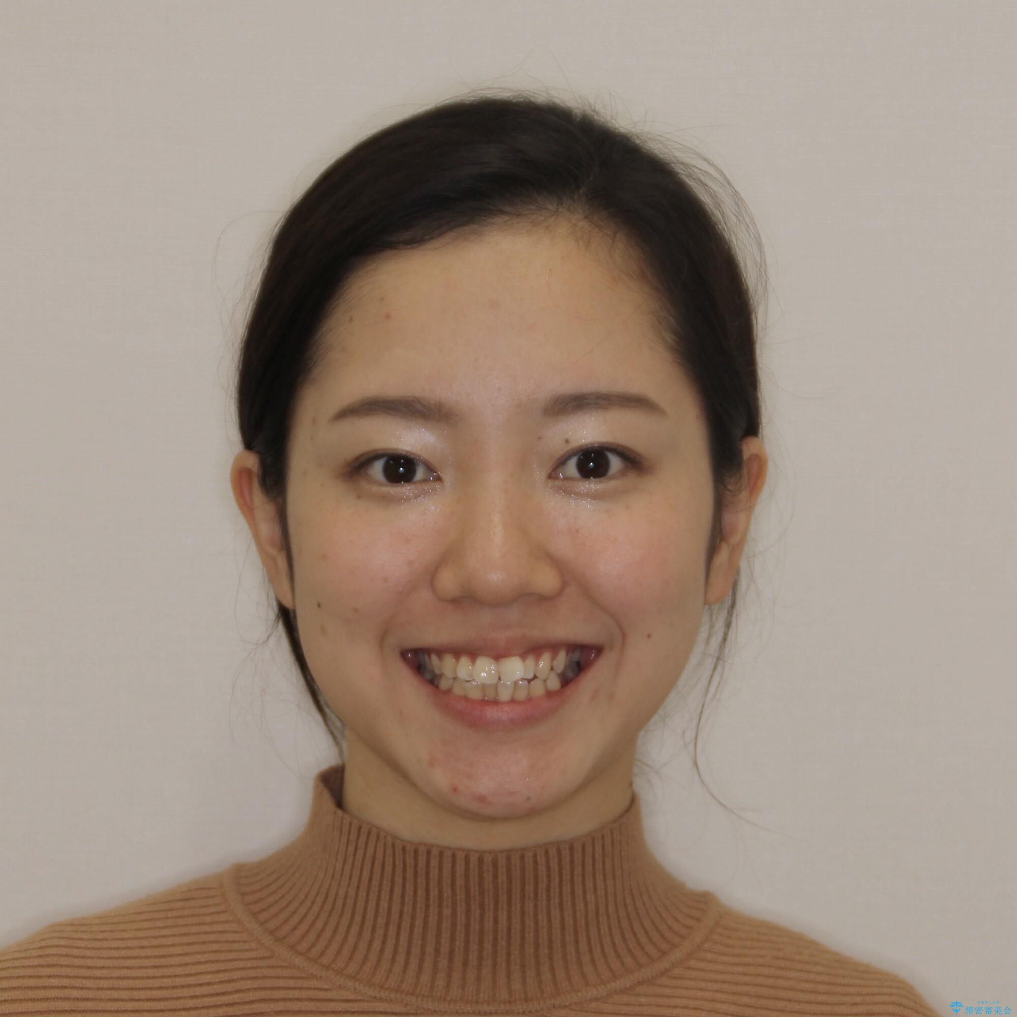 【モニター】オープンバイトをインビザラインで矯正治療の治療前(顔貌)