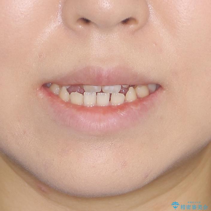 外科矯正は受けたくない 上顎骨拡大による妥協的な受け口治療の治療前(顔貌)