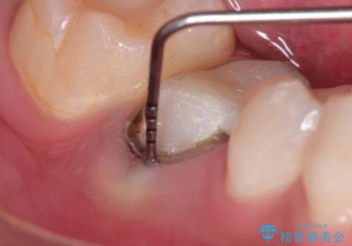 奥歯が痛い オールセラミッククラウン