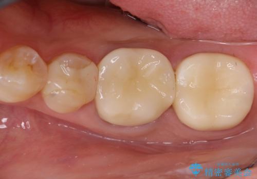 【メタルフリー】オールセラミッククラウンの治療後
