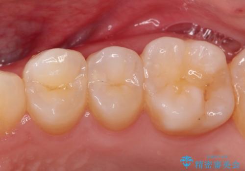 【セラミックインレー】虫歯の治療の治療前