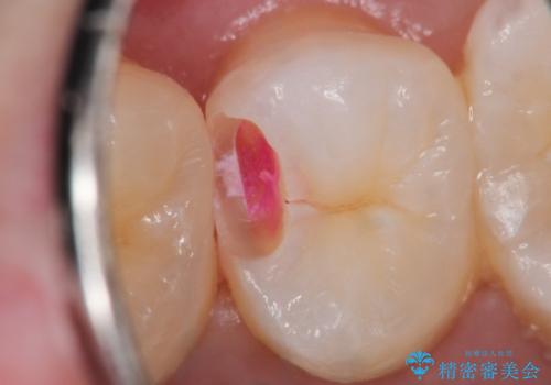 【セラミックインレー】虫歯の治療の治療中