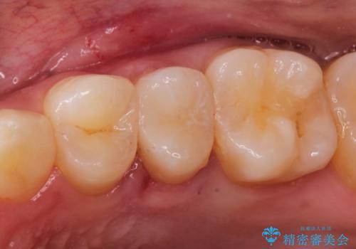 【セラミックインレー】虫歯の治療の治療後
