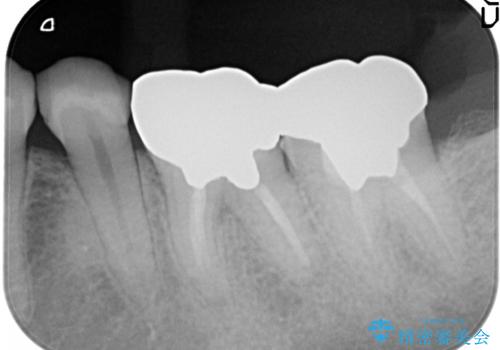 【メタルフリー】オールセラミッククラウンの治療前