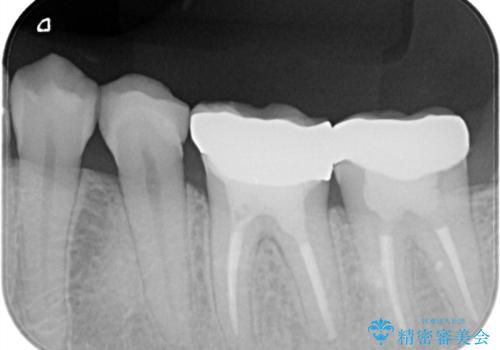 【メタルフリー】オールセラミッククラウンの治療後