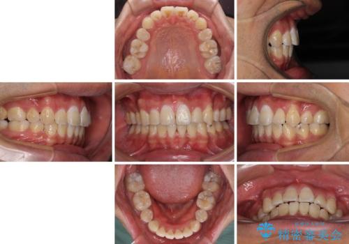 前歯の叢生を解消　ワイヤー装置での抜歯矯正の治療後