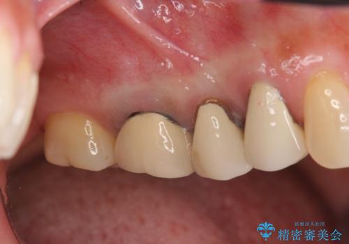古くなったセラミッククラウンのやりかえの症例 治療前