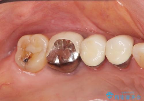 古くなったセラミッククラウンのやりかえの治療前