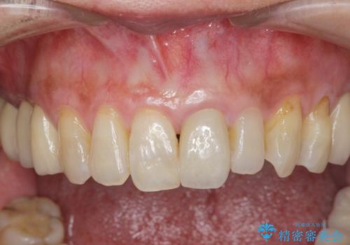 前歯の変色 セラミッククラウンによる審美回復の治療後