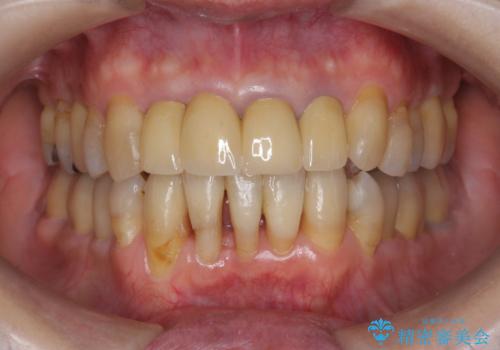矯正を含む全顎治療の症例 治療後