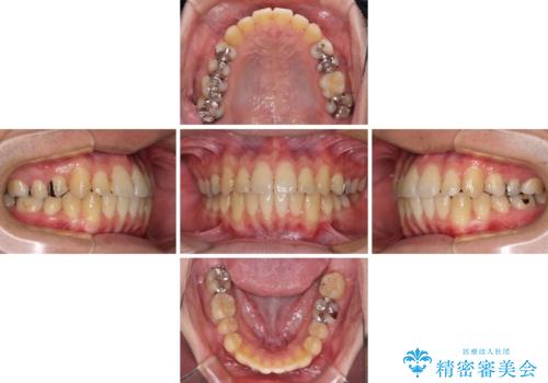 前歯のクロスバイトをインビザラインで矯正治療の治療中