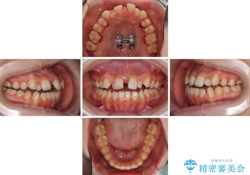 外科矯正は受けたくない 上顎骨拡大による妥協的な受け口治療の治療中