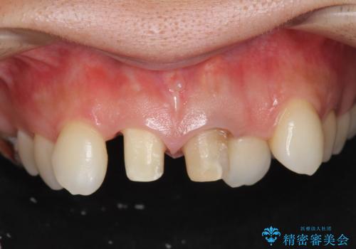 子供の頃にぶつけた前歯 根管治療から行うセラミック治療の治療中