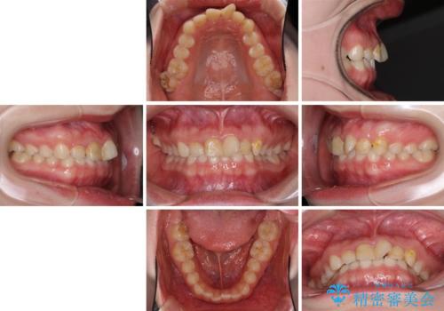 気になる前歯を美しく マウスピース矯正とセラミッククラウンの治療前