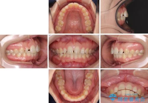 前歯の歯並びと小さい歯を改善　インビザラインとオールセラミッククラウンの治療前