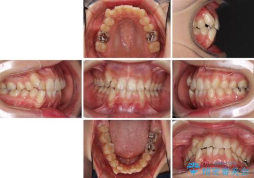 上下の八重歯を治したい　補助装置を用いたインビザライン矯正の治療前