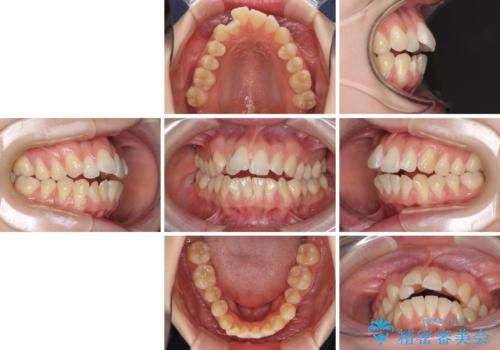 気になるデコボコとオープンバイト インビザラインでの矯正治療の治療前