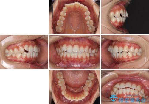前歯のデコボコが気になる インビザラインによる矯正治療の治療前