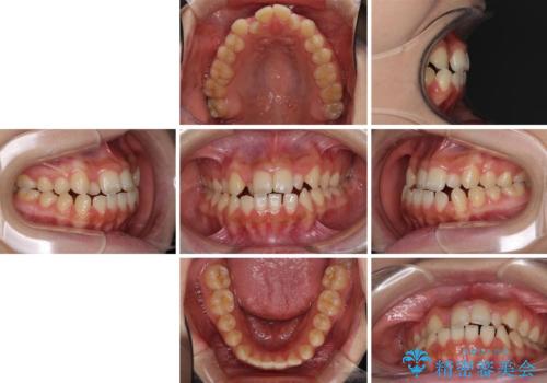 外科矯正は受けたくない 上顎骨拡大による妥協的な受け口治療の治療前