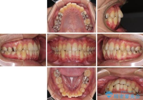 前歯のクロスバイトをインビザラインで矯正治療の治療前
