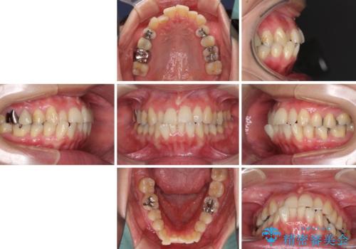 切端咬合をインビザライン矯正で解消の治療前