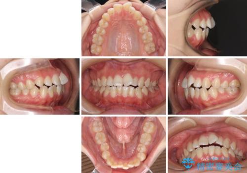 【モニター】オープンバイトをインビザラインで矯正治療の治療前