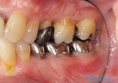 矯正を含む全顎治療の治療前