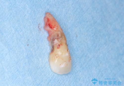 子供の頃にぶつけた前歯 根管治療から行うセラミック治療の治療前