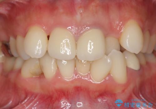 子供の頃にぶつけた前歯 根管治療から行うセラミック治療の治療後