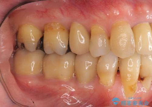 矯正を含む全顎治療の治療後
