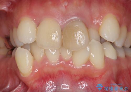 子供の頃にぶつけた前歯 根管治療から行うセラミック治療の治療前