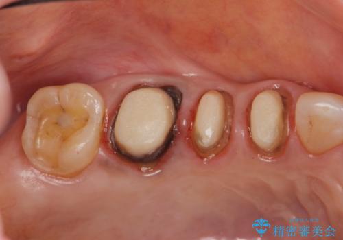 古くなったセラミッククラウンのやりかえの治療中