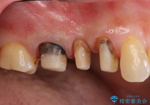 古くなったセラミッククラウンのやりかえの治療中