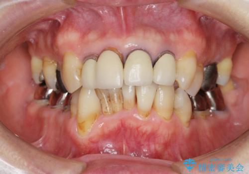 矯正を含む全顎治療の症例 治療前