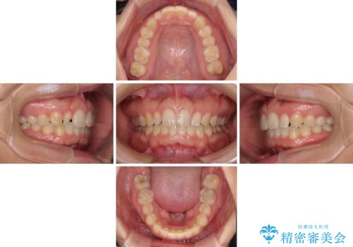 前歯の歯並びと小さい歯を改善 インビザラインとオールセラミッククラウンの治療中