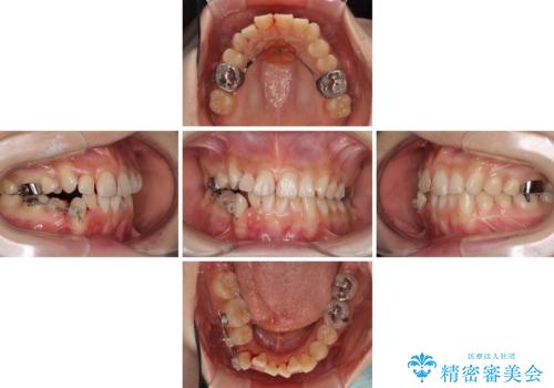 上下の八重歯を治したい 補助装置を用いたインビザライン矯正の治療中