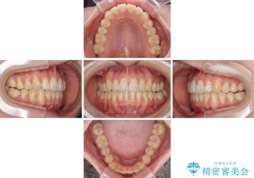 気になるデコボコとオープンバイト インビザラインでの矯正治療の治療中