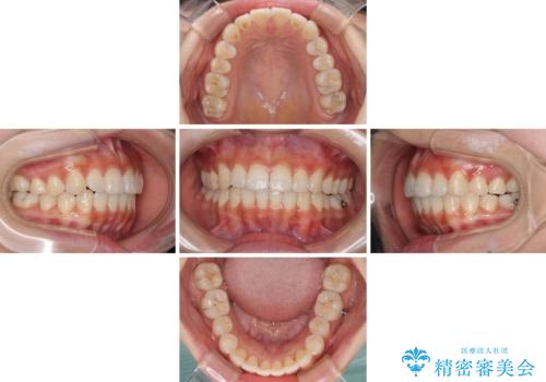 前歯のデコボコが気になる インビザラインによる矯正治療の治療中