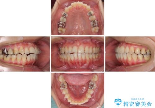 切端咬合をインビザライン矯正で解消の治療中