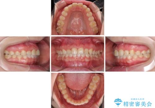 気になる前歯を美しく マウスピース矯正とセラミッククラウンの治療中