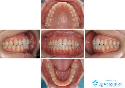 【モニター】オープンバイトをインビザラインで矯正治療の治療中