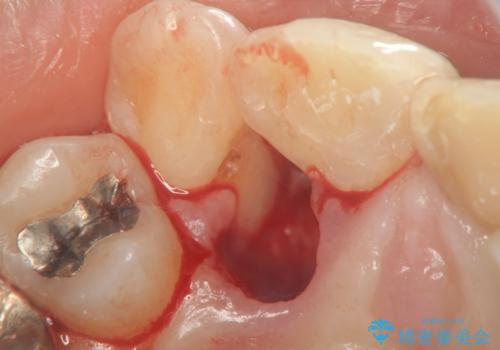 子供の頃にぶつけた前歯 根管治療から行うセラミック治療の治療前